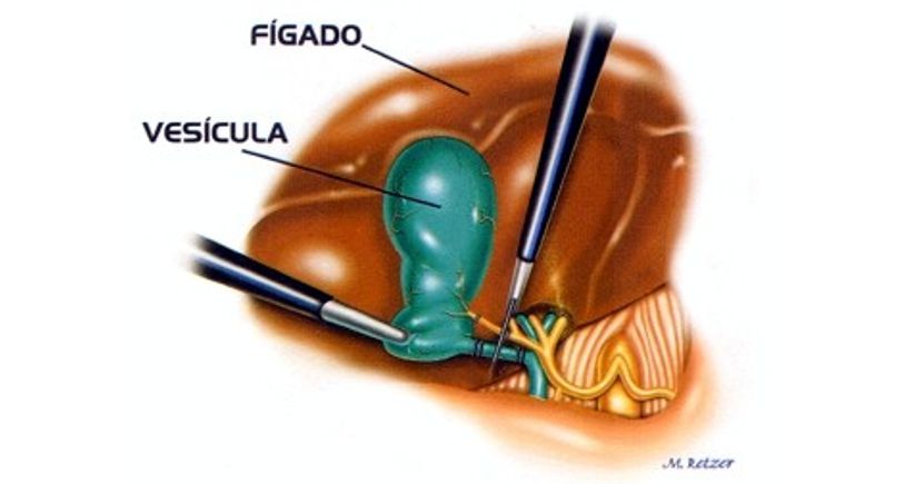 Cálculo (Pedra) da Vesícula